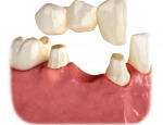 Dental bridge for tooth replacement.