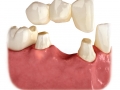 Dental bridge for tooth replacement.