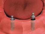 2 - 4 implants are placed with ball-top posts that attach to denture.