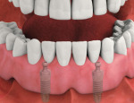 Modified denture snapped into place providing stability and confidence.