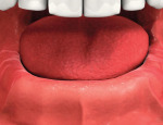 Patient unhappy with denture instability