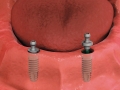 2 - 4 implants are placed with ball-top posts that attach to denture.