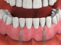 Modified denture snapped into place providing stability and confidence.