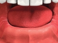 Patient unhappy with denture instability