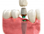A single tooth replacement.