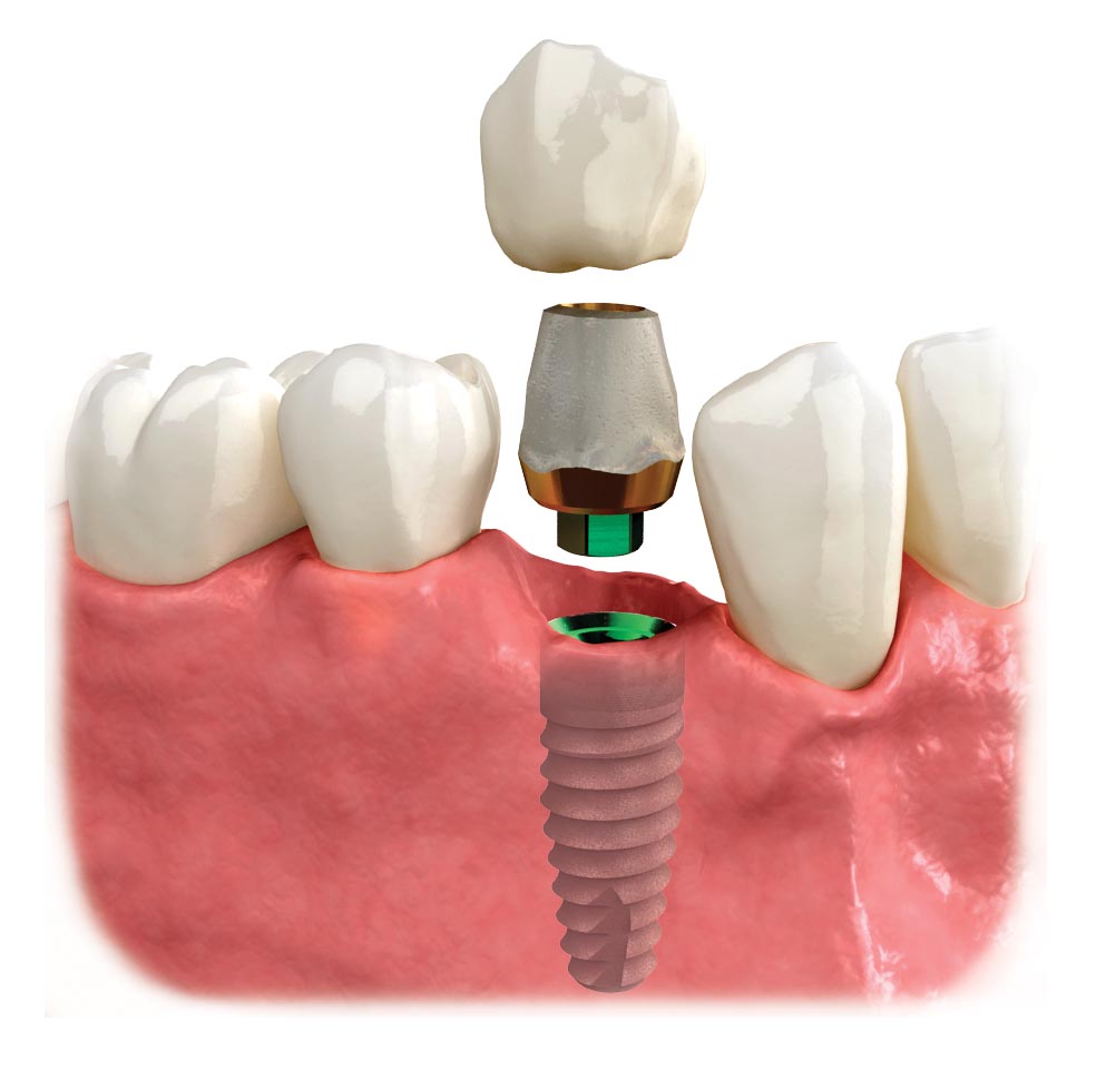 patient-ed-single-implant2.jpg