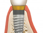 implantfinal