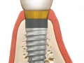 implantfinal