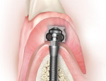 MDI Lower Jaw Cross Section