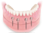 MDI Mandible