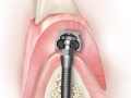 MDI Lower Jaw Cross Section