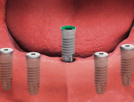 Dental implant replacement.