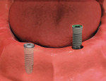 Dental implant replacement.