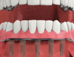 Overdenture attached.