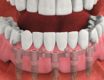 Overdenture attached.