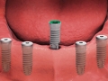 Dental implant replacement.