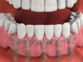 Overdenture attached.