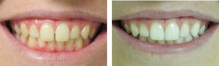 before and after photo tooth bonding