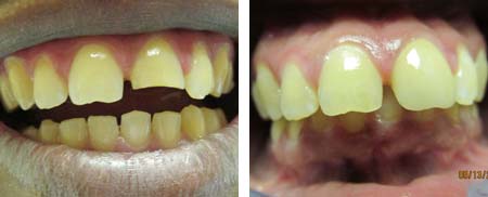 before and after photo tooth crown replacement