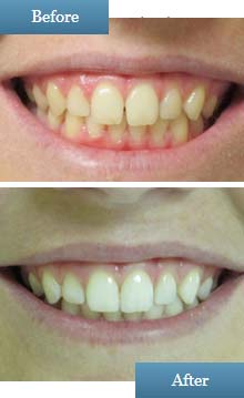 before and after photo tooth whitening