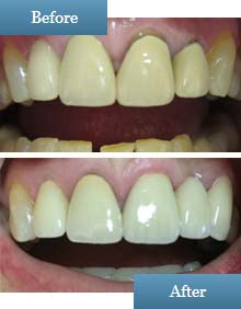 before / after dental bridge photo