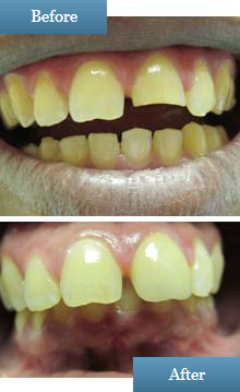 before after photo tooth crown