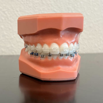 clear brackets from Six Month Smiles®