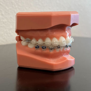 clear brackets from Six Month Smiles®